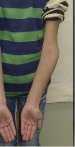 8. An 8-year-old male presents with the following presentation of the elbow .jpg
