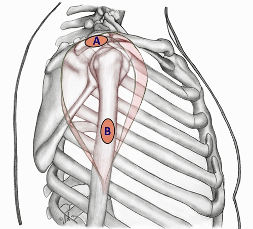 BS1SALateral approach shoulder 2.jpg