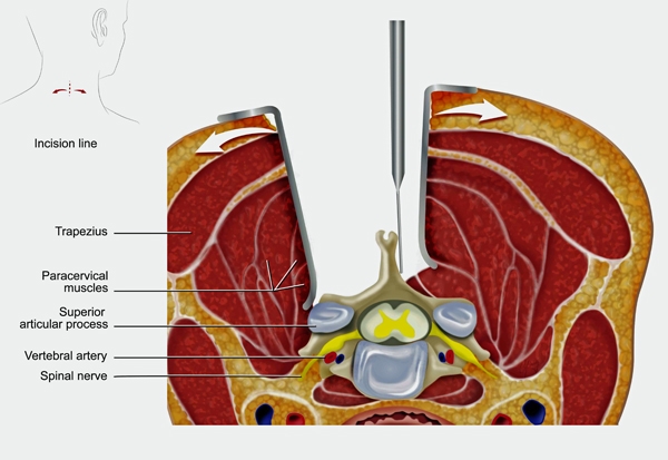 BS1SAPost cervical spine 1.jpg